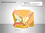 Prostate and Seminal Vesicles Diagram slide 10