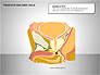 Prostate and Seminal Vesicles Diagram slide 11