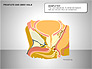 Prostate and Seminal Vesicles Diagram slide 12