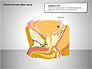 Prostate and Seminal Vesicles Diagram slide 18
