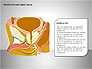 Prostate and Seminal Vesicles Diagram slide 19