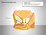 Prostate and Seminal Vesicles Diagram slide 6