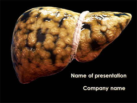Nonalcoholic Fatty Liver Disease Presentation Template, Master Slide
