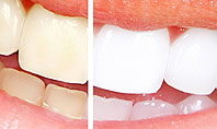 Teeth Whitening Presentation Template